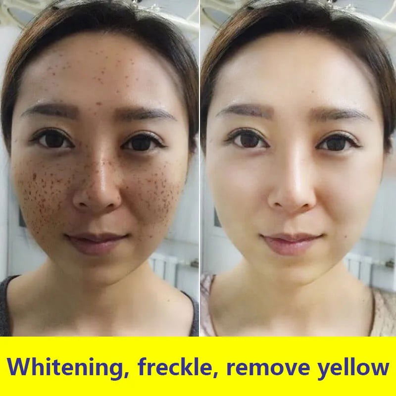 BAIZTON Whitening Anti Freckle Cream (Facial) - China To BD Web
