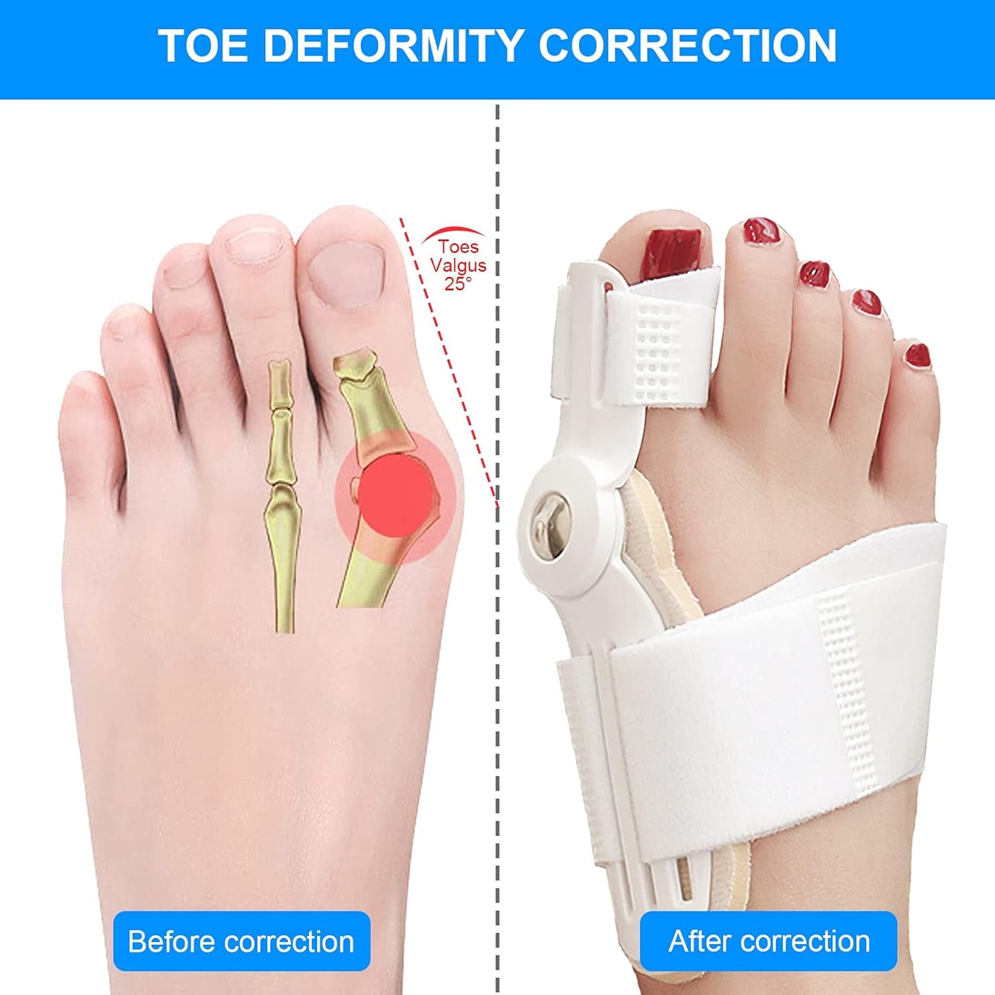 Orthopedic Bunion Corrector Device Hallux Valgus Toe Correction Pedicure Foot Care Tool Thumb Big Bone Orthotics - China To BD Web