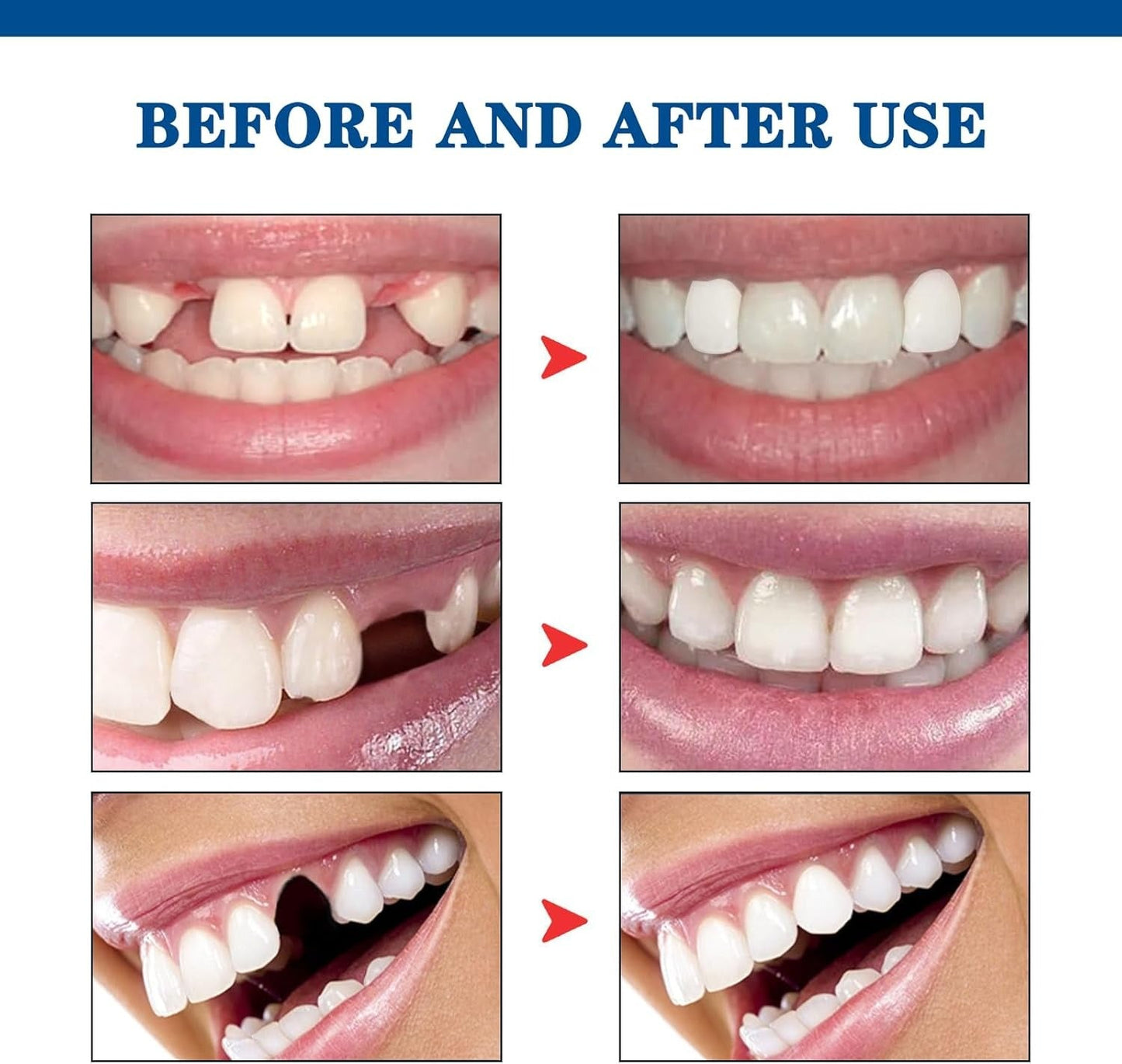 Temporary Moldable Tooth Repair Kit-30ml-3pcs